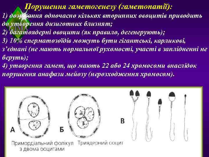   Порушення гаметогенезу (гаметопатії): 1) дозрівання одночасно кількох вторинних овоцитів приводить до утворення