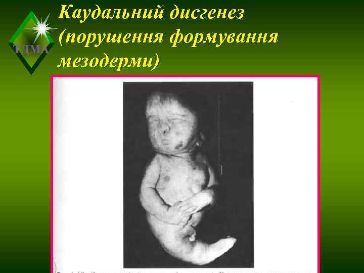   Каудальний дисгенез  (порушення формування ТДМА  мезодерми) 