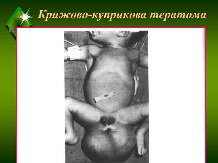   Крижово-куприкова тератома ТДМА 