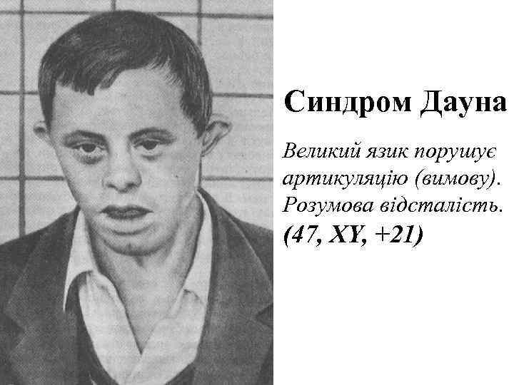 Синдром Дауна Великий язик порушує артикуляцію (вимову). Розумова відсталість. (47, XY, +21) 