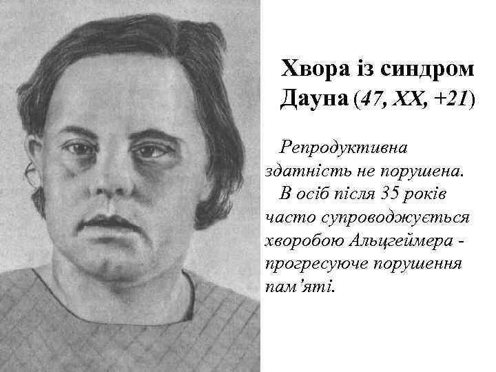  Хвора із синдром  Дауна (47, XX, +21)  Репродуктивна здатність не порушена.