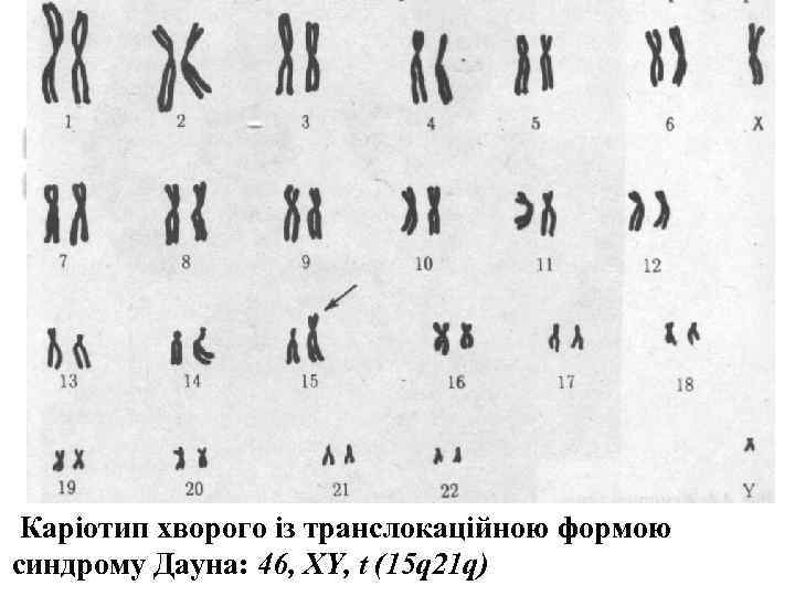  Каріотип хворого із транслокаційною формою  синдрому Дауна: 46, XY, t (15 q