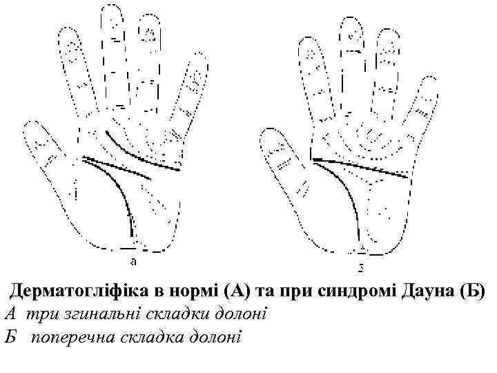  Дерматогліфіка в нормі (А) та при синдромі Дауна (Б) А три згинальні складки