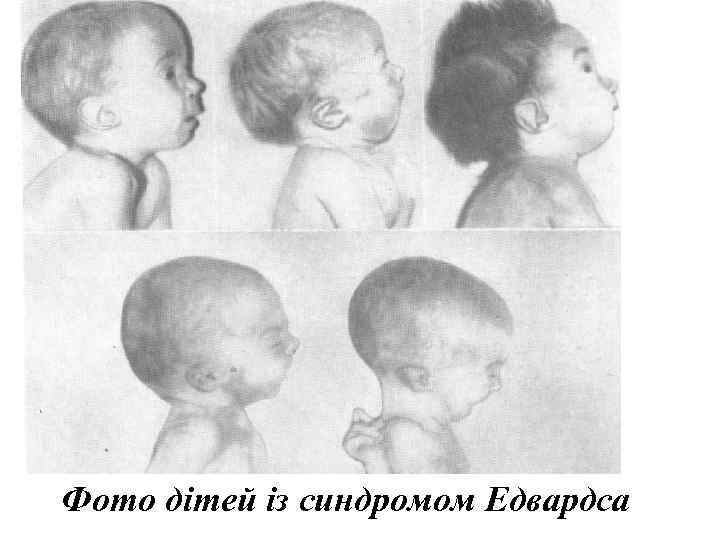 Фото дітей із синдромом Едвардса 