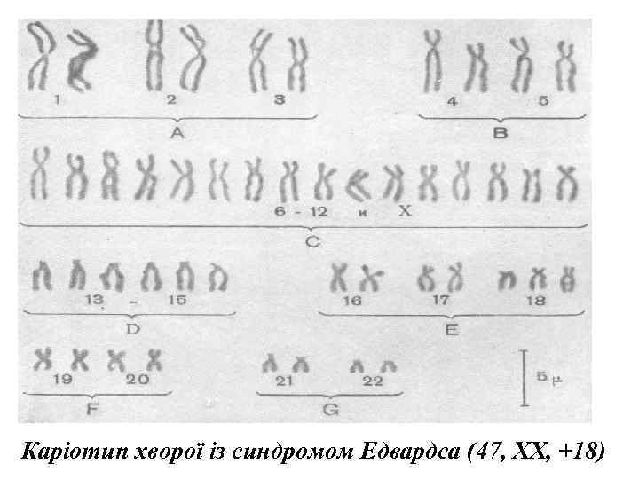 Каріотип хворої із синдромом Едвардса (47, XX, +18)  