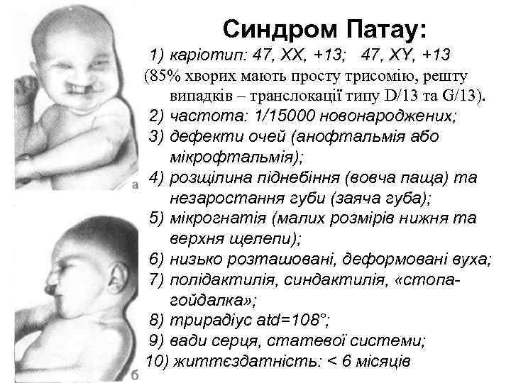    Синдром Патау:  1) каріотип: 47, XX, +13; 47, XY, +13