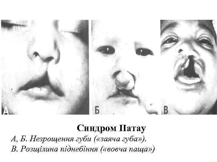    Синдром Патау A, Б. Незрощення губи ( «заяча губа» ). В.