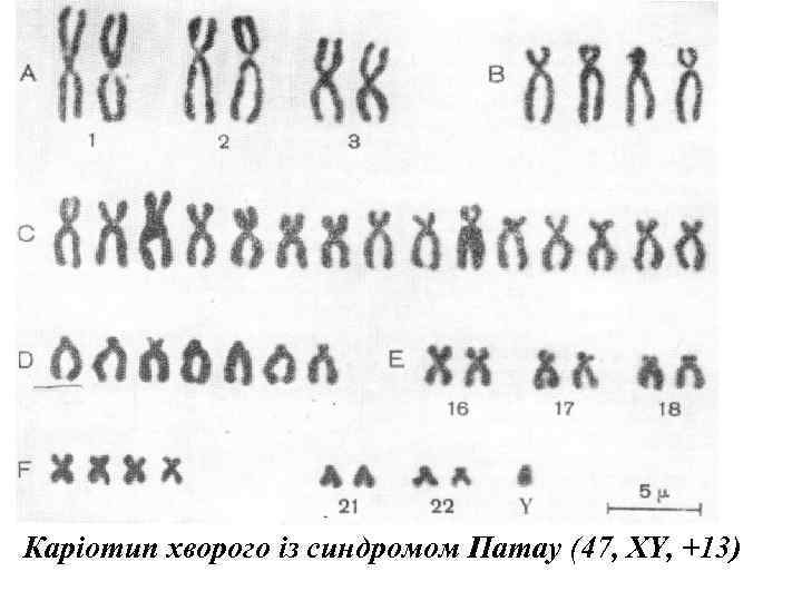 Каріотип хворого із синдромом Патау (47, XY, +13) 