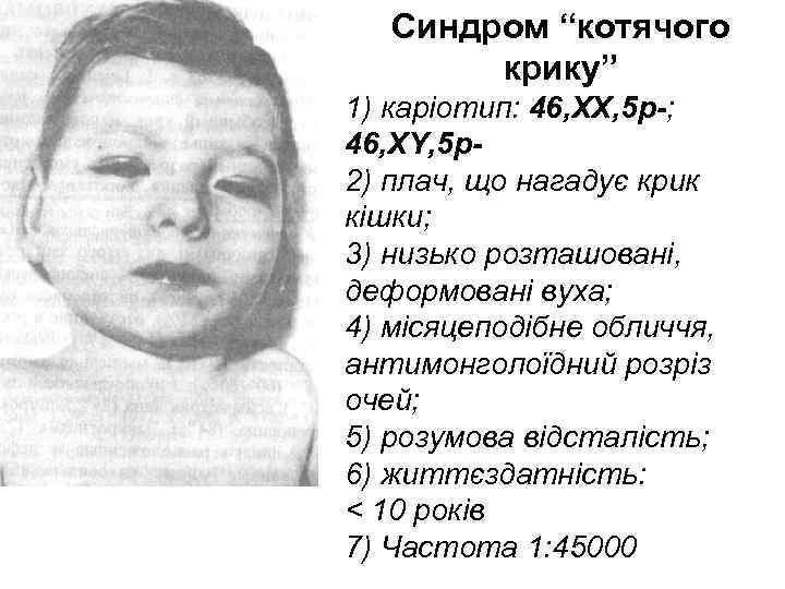   Синдром “котячого   крику” 1) каріотип: 46, XX, 5 p-; 46,