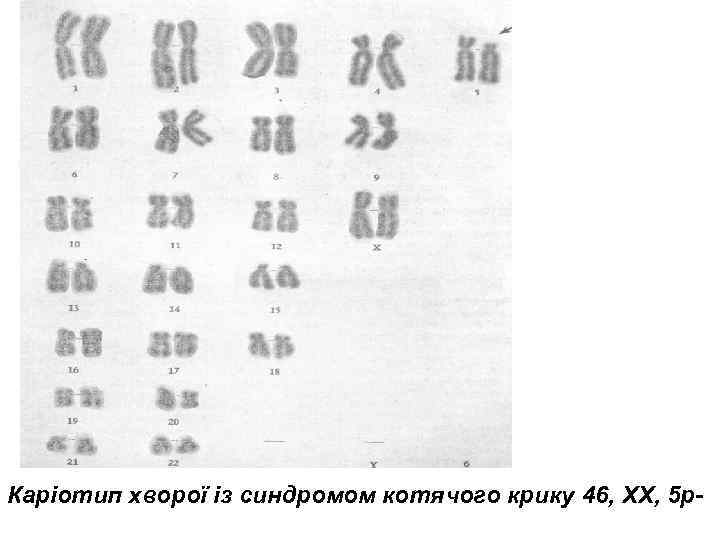 Каріотип хворої із синдромом котячого крику 46, XX, 5 p- 