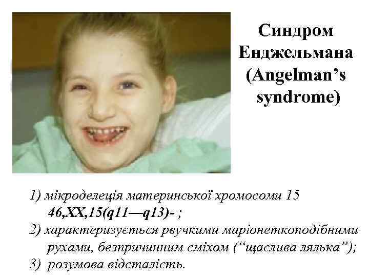      Синдром     Енджельмана   