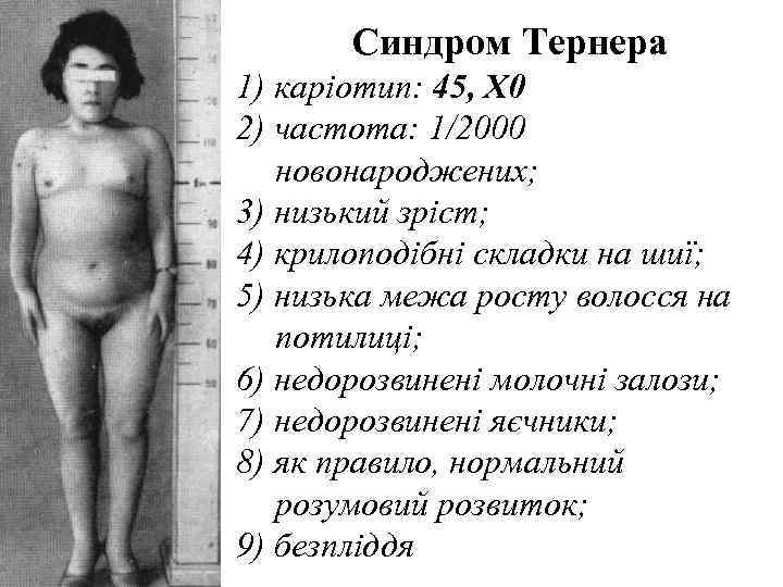   Синдром Тернера 1) каріотип: 45, X 0 2) частота: 1/2000  новонароджених;