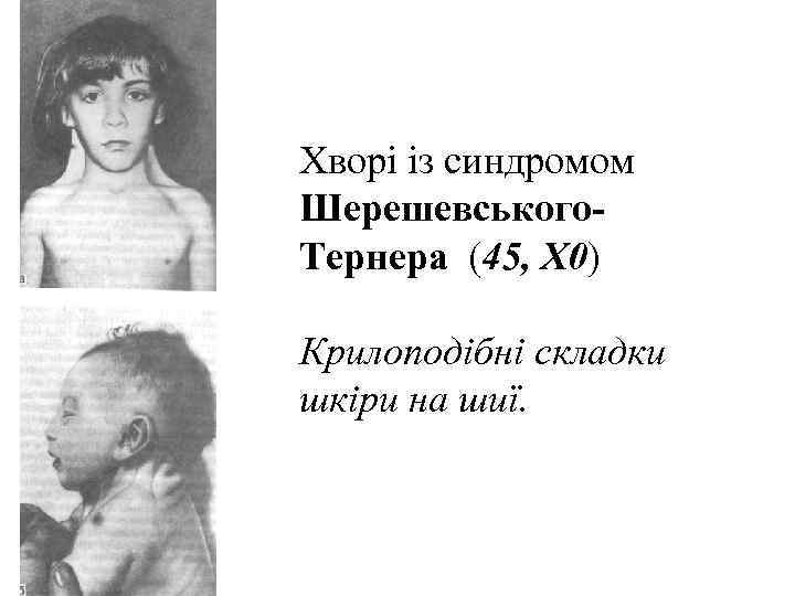 Хворі із синдромом Шерешевського- Тернера (45, X 0) Крилоподібні складки шкіри на шиї. 