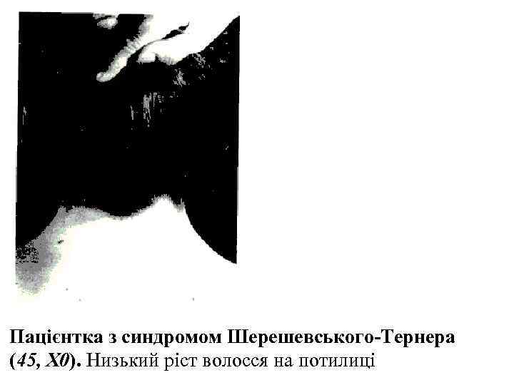 Пацієнтка з синдромом Шерешевського-Тернера  (45, X 0). Низький ріст волосся на потилиці 