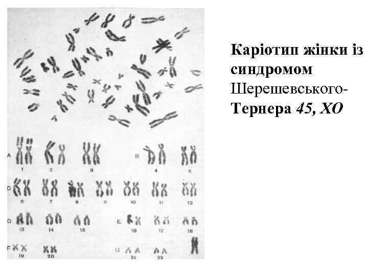 Каріотип жінки із синдромом Шерешевського- Тернера 45, XO 