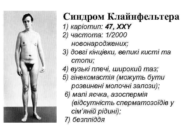Синдром Клайнфельтера 1) каріотип: 47, XXY 2) частота: 1/2000  новонароджених; 3) довгі кінцівки,