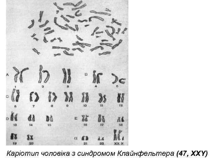 Каріотип чоловіка з синдромом Клайнфельтера (47, XXY) 