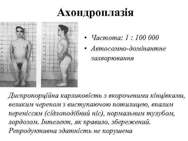    Ахондроплазія     • Частота: 1 : 100 000