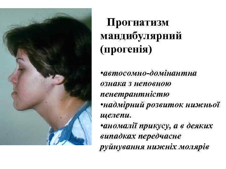   Прогнатизм мандибулярний (прогенія)  • автосомно-домінантна ознака з неповною пенетрантністю • надмірний
