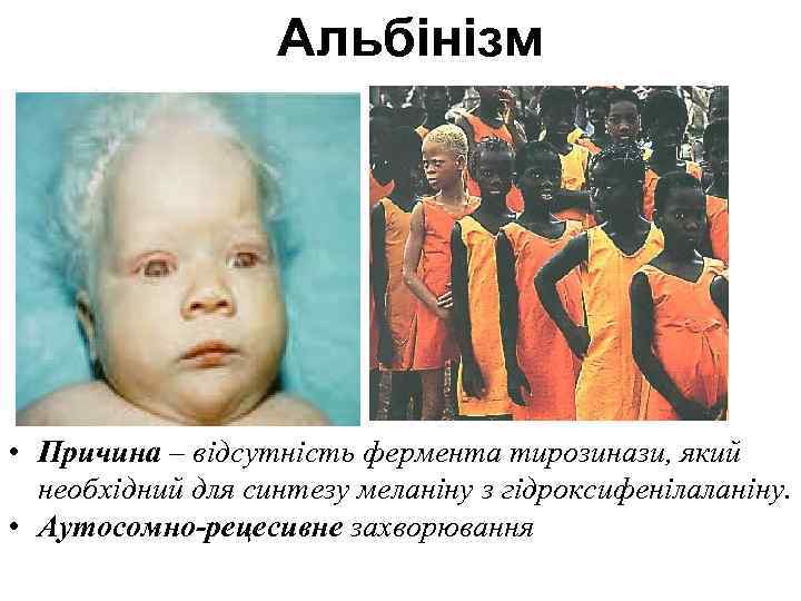     Альбінізм • Причина – відсутність фермента тирозинази, який  необхідний