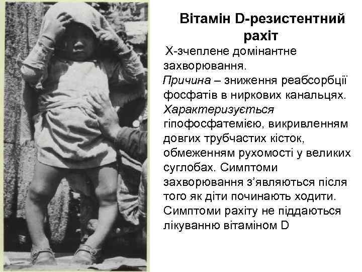   Вітамін D-резистентний   рахіт Х-зчеплене домінантне захворювання. Причина – зниження реабсорбції