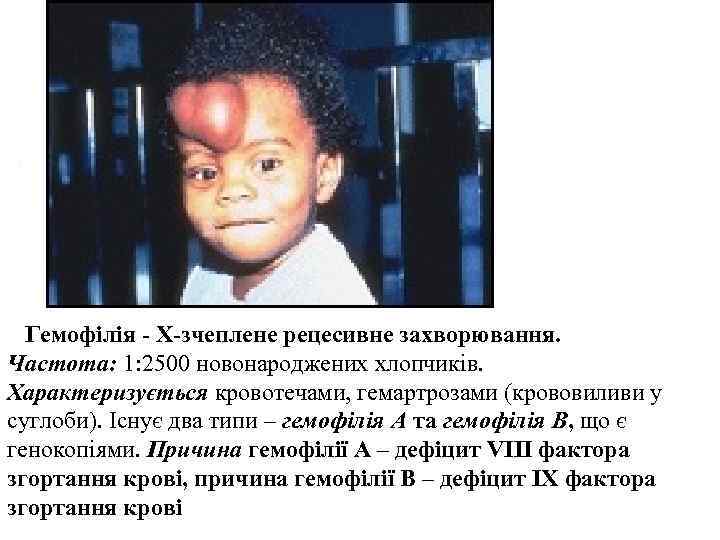   Гемофілія - Х-зчеплене рецесивне захворювання.  Частота: 1: 2500 новонароджених хлопчиків. 