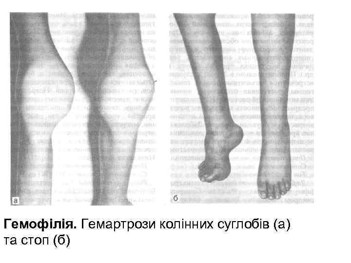 Гемофілія. Гемартрози колінних суглобів (а) та стоп (б) 