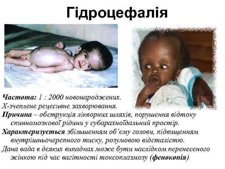    Гідроцефалія Частота: 1 : 2000 новонароджених. Х-зчеплене рецесивне захворювання. Причина –