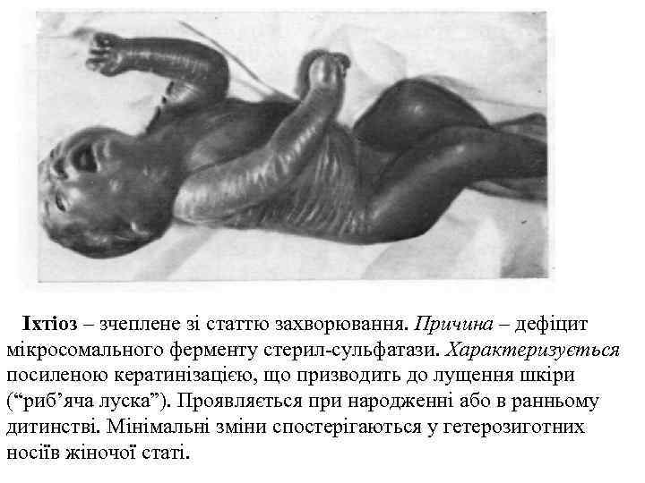   Іхтіоз – зчеплене зі статтю захворювання. Причина – дефіцит мікросомального ферменту стерил-сульфатази.