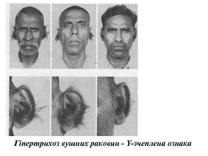 Гіпертрихоз вушних раковин - Y-зчеплена ознака 
