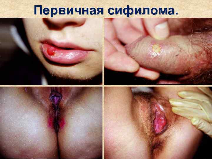 Первичная сифилома. 