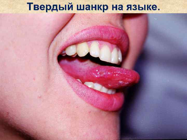 Твердый шанкр на языке. 