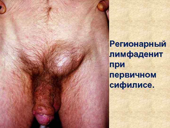 Регионарный лимфаденит при первичном сифилисе. 