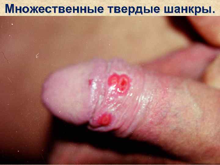 Множественные твердые шанкры. 