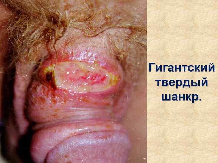 Гигантский твердый  шанкр. 