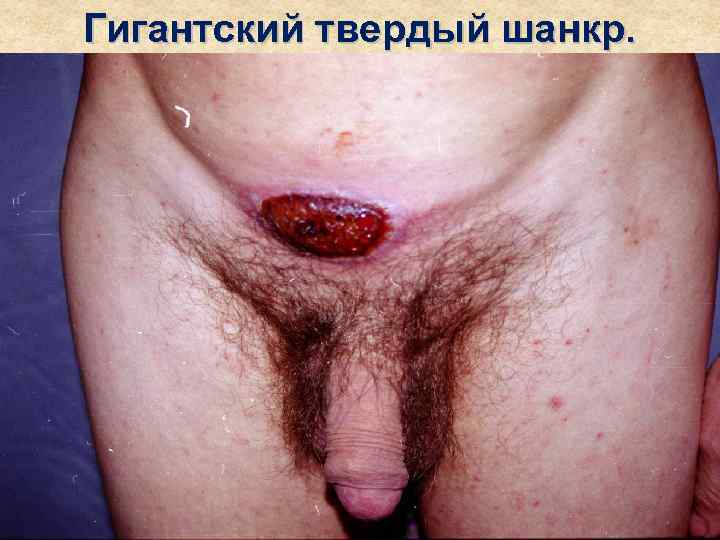 Гигантский твердый шанкр. 