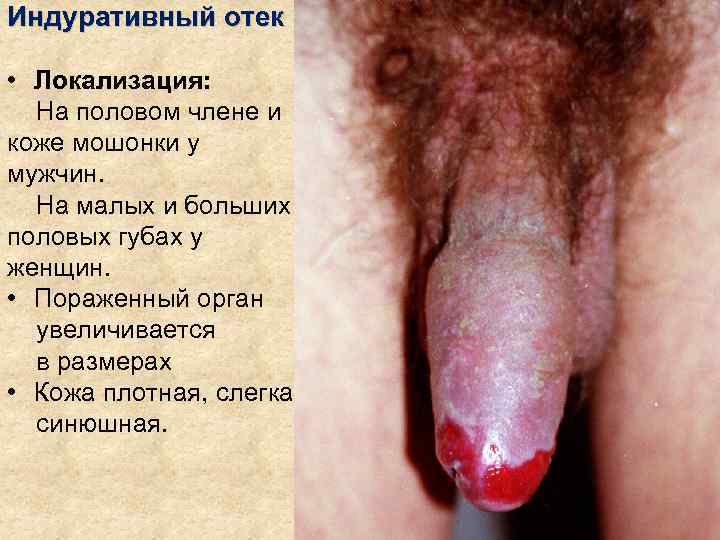 Индуративный отек  • Локализация:  На половом члене и коже мошонки у мужчин.