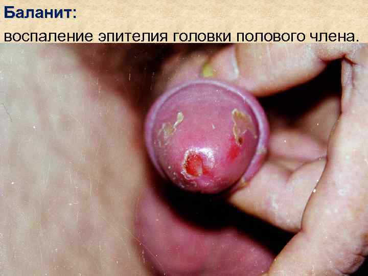 Баланит: воспаление эпителия головки полового члена. 