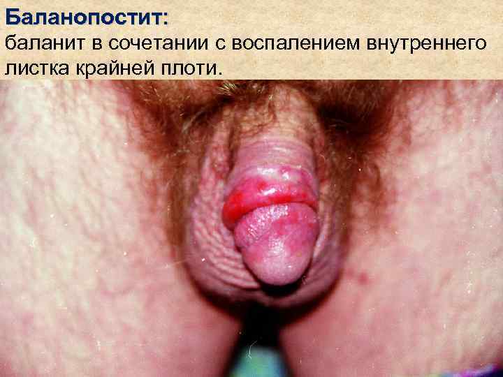 Баланопостит: баланит в сочетании с воспалением внутреннего листка крайней плоти. 
