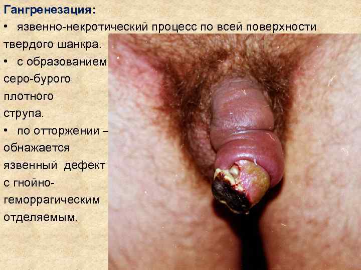 Гангренезация:  • язвенно-некротический процесс по всей поверхности твердого шанкра.  • с образованием