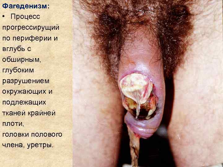 Фагеденизм:  • Процесс прогрессирущий по периферии и вглубь с обширным, глубоким разрушением окружающих