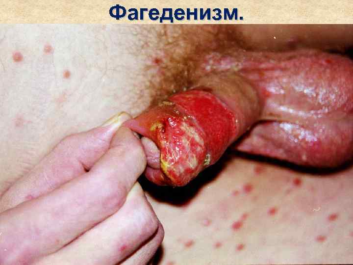 Фагеденизм. 