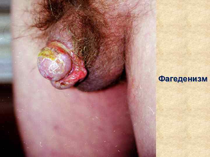 Фагеденизм 