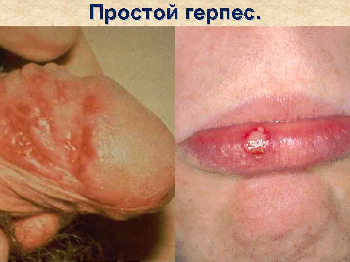 Простой герпес. 
