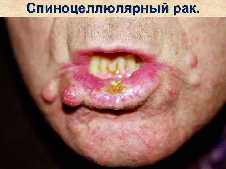 Спиноцеллюлярный рак. 
