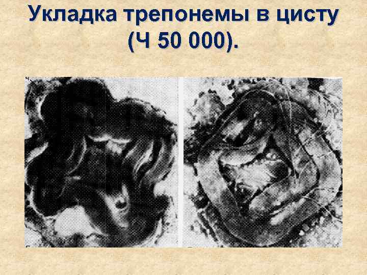 Укладка трепонемы в цисту   (Ч 50 000). 