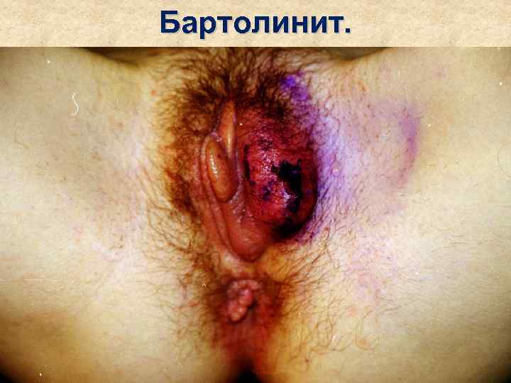 Бартолинит. 