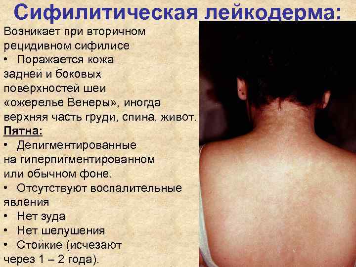 Сифилитическая лейкодерма: Возникает при вторичном рецидивном сифилисе • Поражается кожа задней и боковых Сифилитическая лейкодерма: Возникает при вторичном рецидивном сифилисе • Поражается кожа задней и боковых