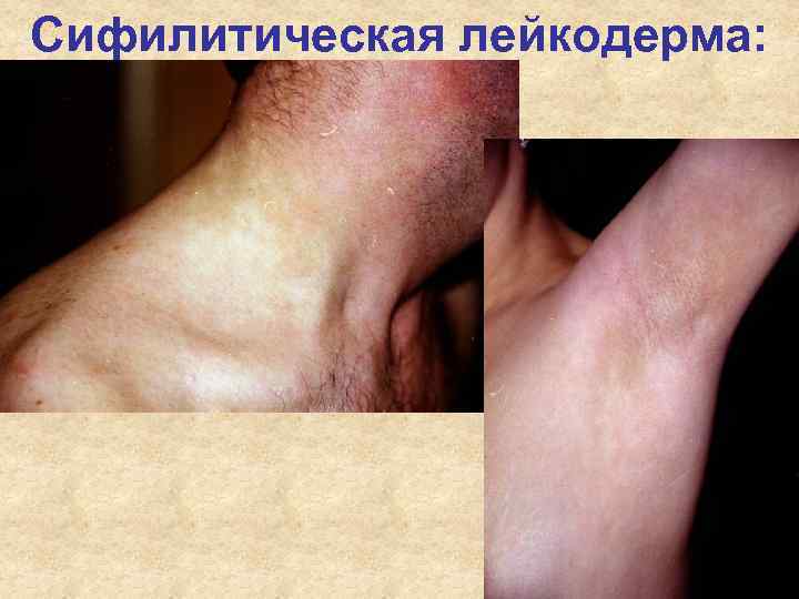 Сифилитическая лейкодерма: Сифилитическая лейкодерма:
