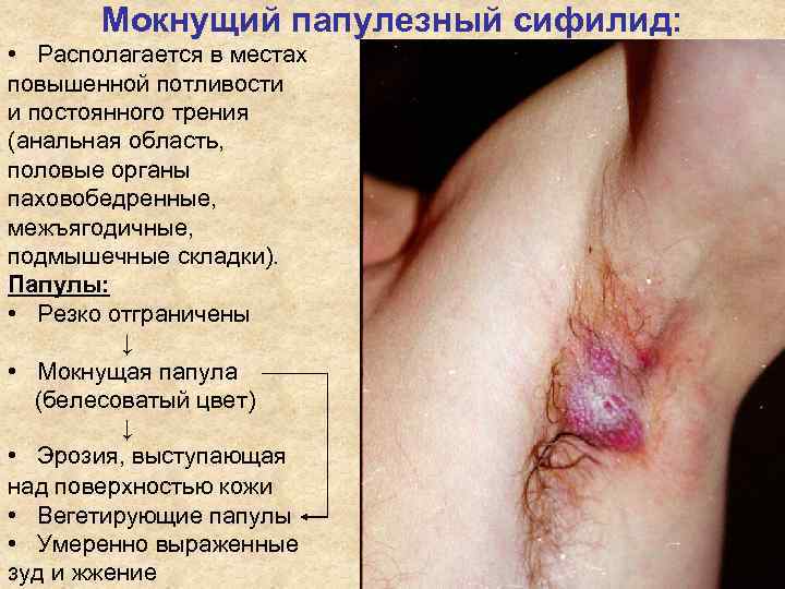 Мокнущий папулезный сифилид: • Располагается в местах повышенной потливости и постоянного Мокнущий папулезный сифилид: • Располагается в местах повышенной потливости и постоянного